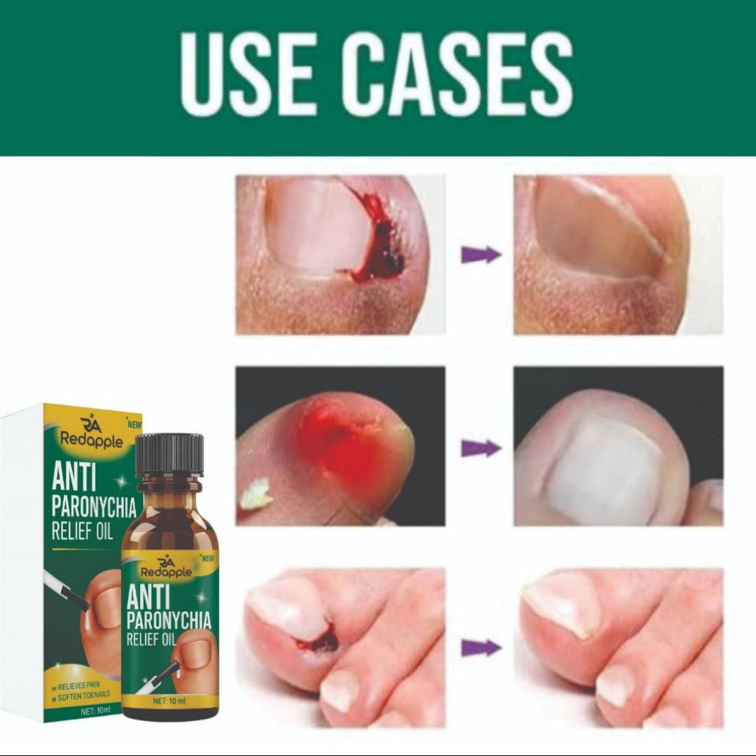 Anti Paronychia Relief Oil - (Buy 1 Get 1 FREE🔥🔥)